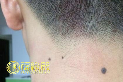 男人脖子后面有痣代表什么 到底好不好(圖文)