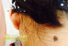 脖子后面有痣代表什么意思你知道嗎