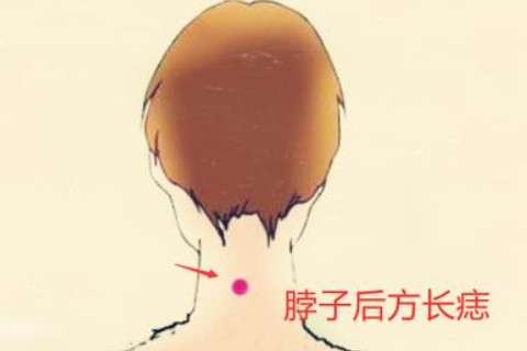 面相：脖子后面有痣的命運解析