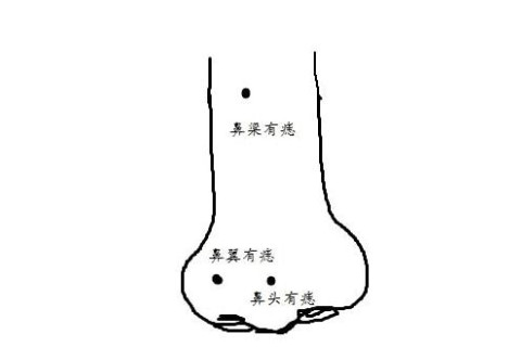 面相：鼻子有痣有著什么意思呢？