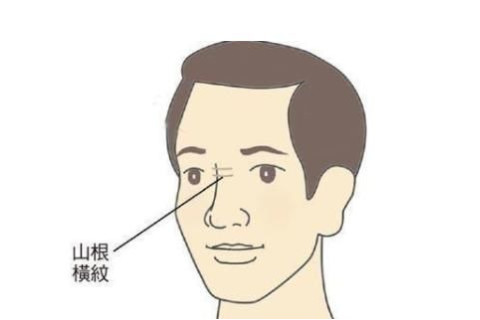 面相分析：山根有橫紋的人感情運勢怎么樣？