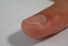 夢見自己手指甲斷了