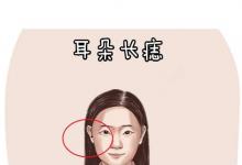 女人右耳垂有痣運(yùn)勢(shì)分析