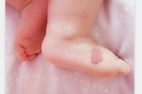 痣相分析男人腳后跟有痣代表什么?是惡痣嗎