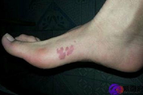 腳底長(zhǎng)痣有什么含義?腳底有痣代表什么